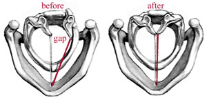 Paralysis of Vocal Cord