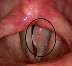 HPV - Papillomas of the Larynx