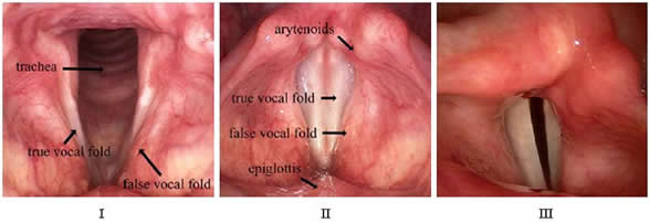 Vocal Cord Paralysis